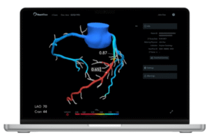 HeartFlow FFRCT Analysis on Laptop Screen